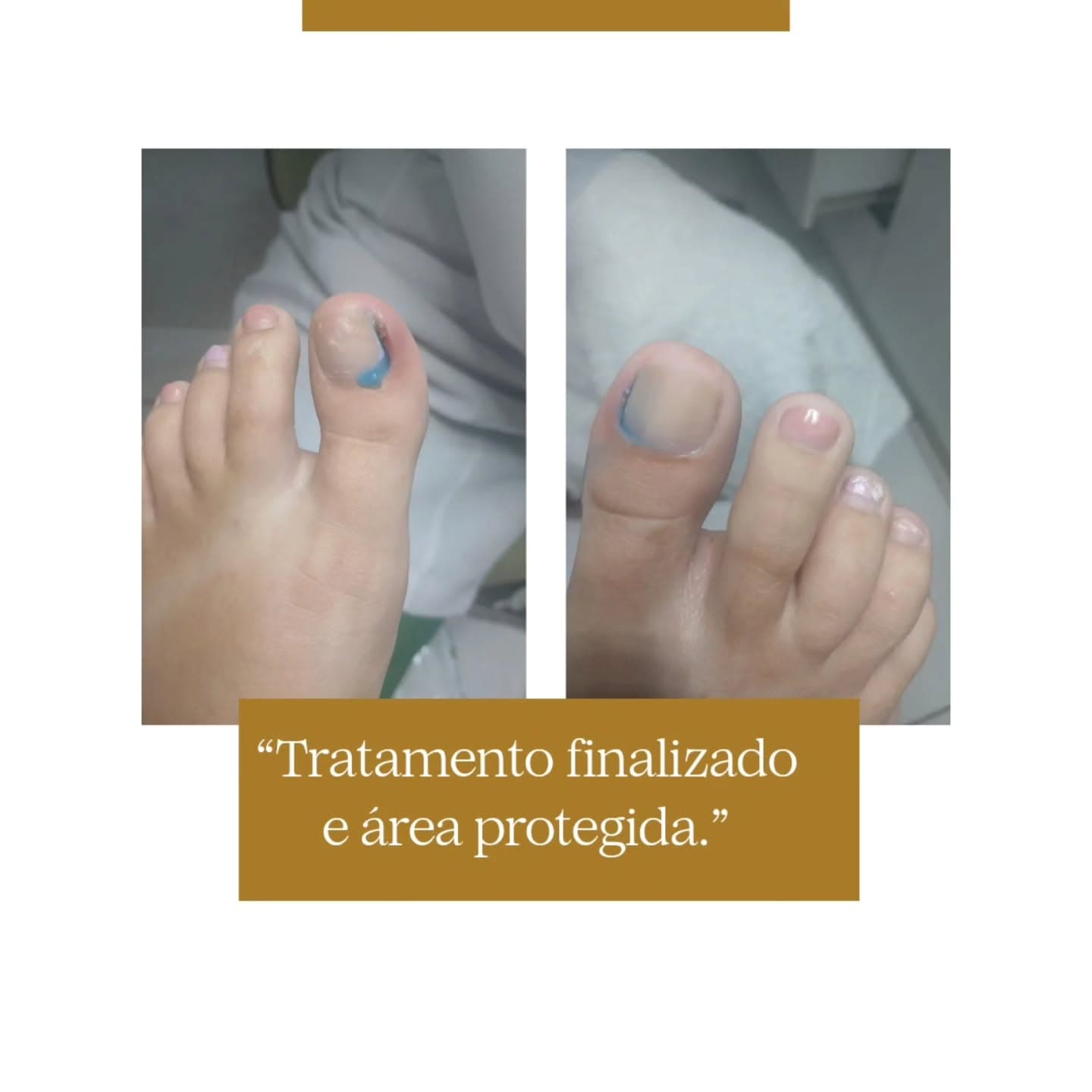 Cuidado complementar após o procedimento de unha encravada na ZL Podologia