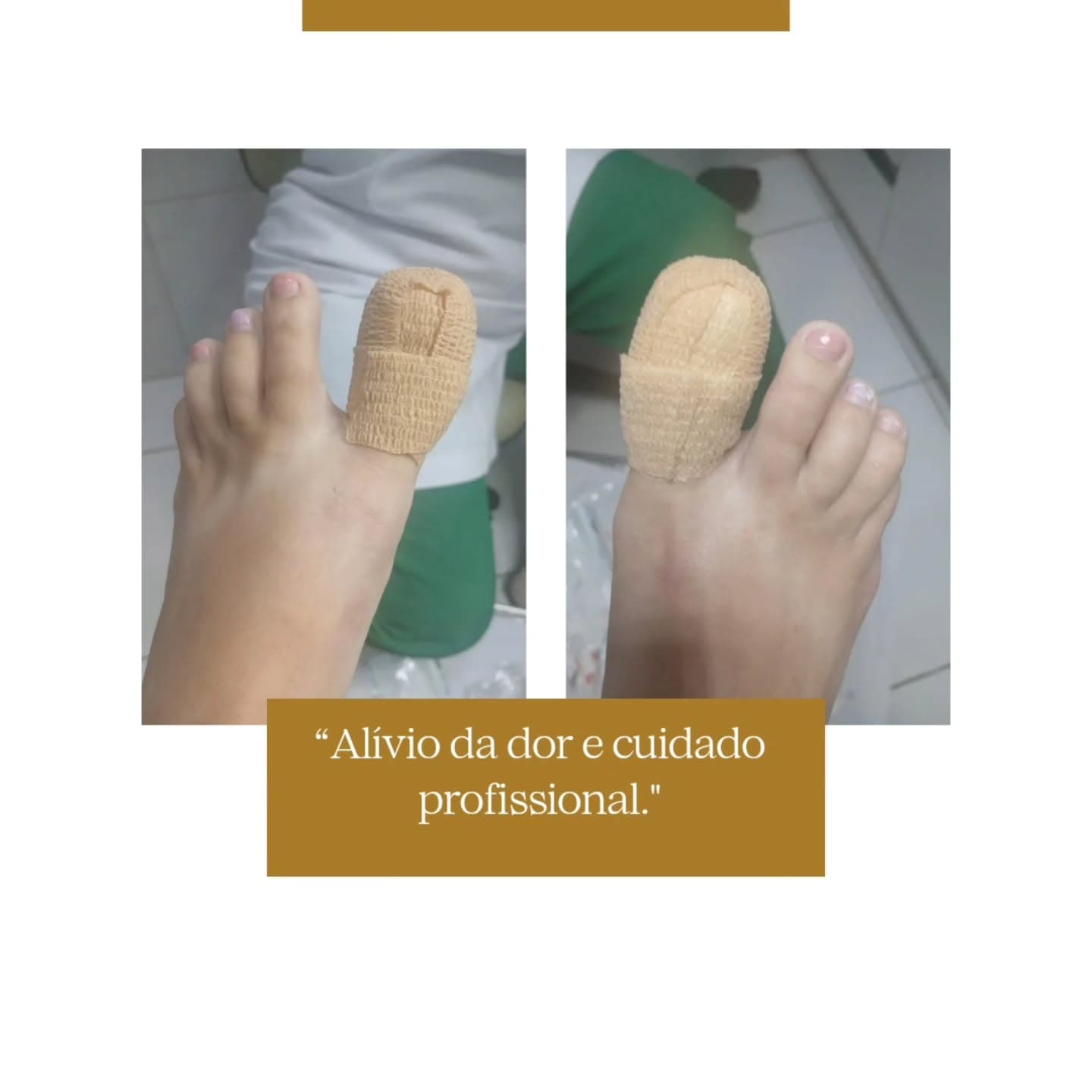 Alívio da dor e bandagem protetiva após o atendimento de unha encravada na ZL Podologia Fortaleza
