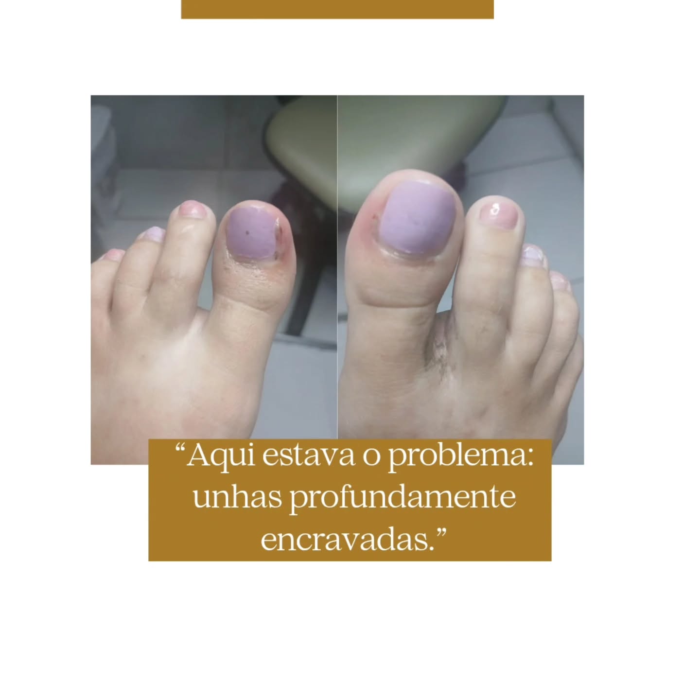 Leitura clínica das unhas encravadas - diagnóstico visual antes do procedimento