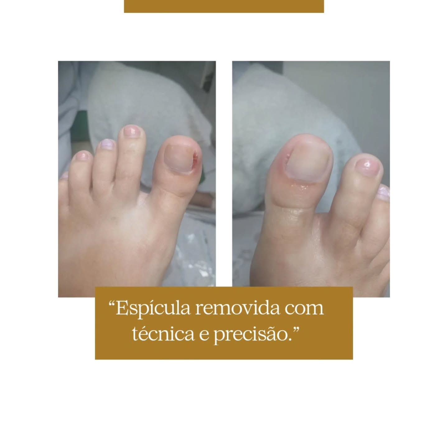 Retirada técnica da espícula da unha encravada com instrumental profissional na ZL Podologia