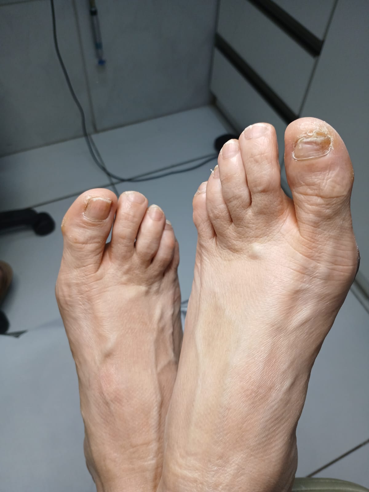 Registro autorizado de unha com suspeita de fungo antes do protocolo