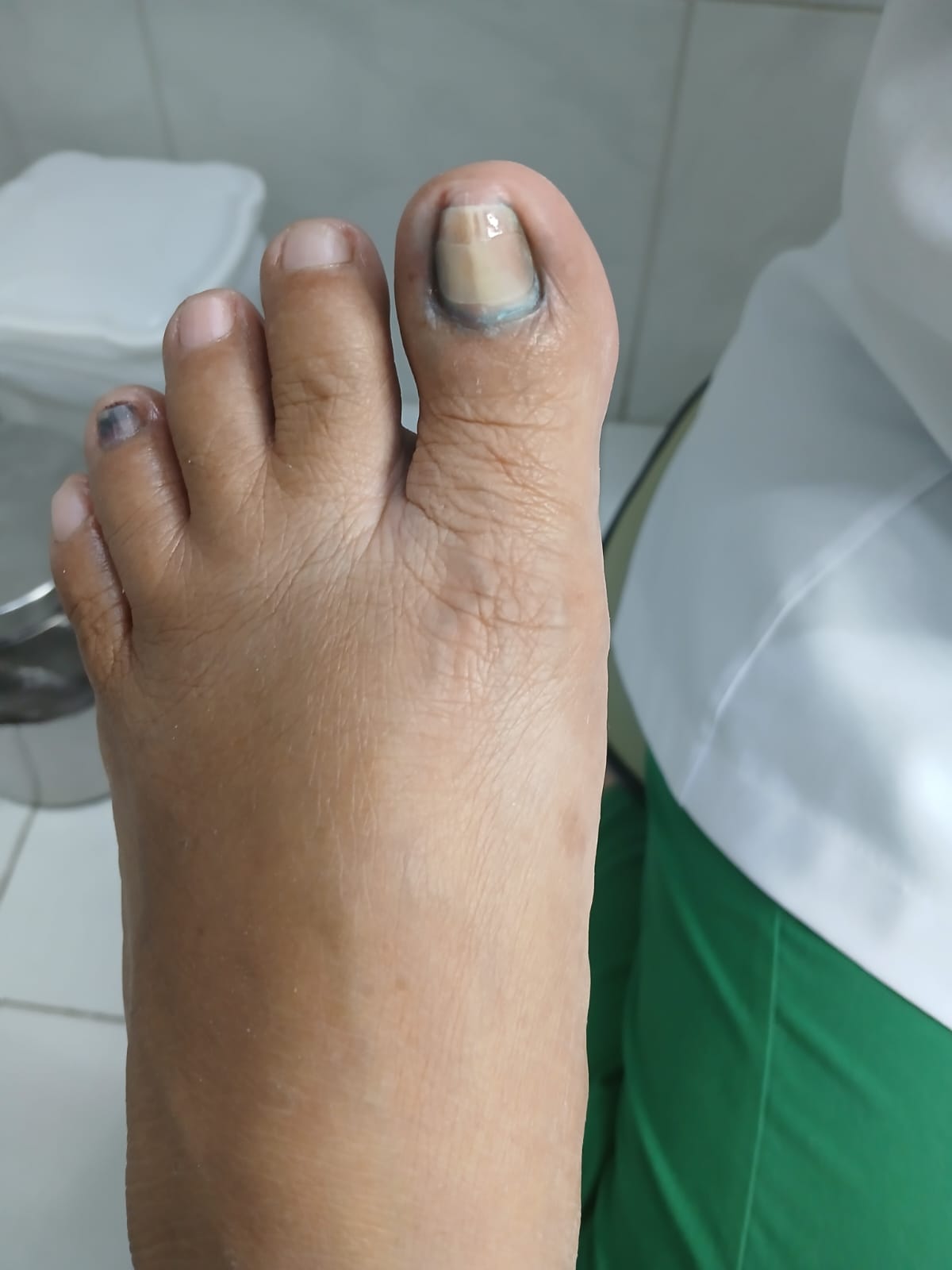 Acabamento clínico após sessão de podoprofilaxia com protocolo finalizado na ZL Podologia Fortaleza