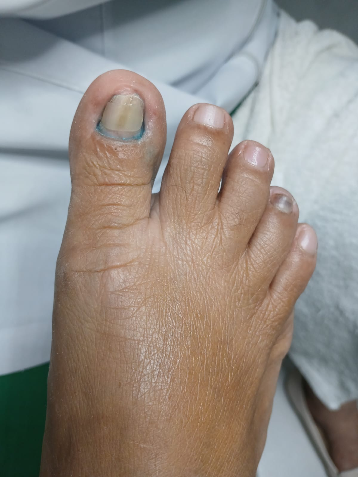 Antes: hálux com unha amarelada e aplicação de azul de metileno - estado após o início do tratamento de fungos na ZL Podologia Fortaleza